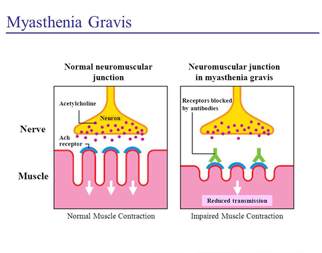 myasthenia
